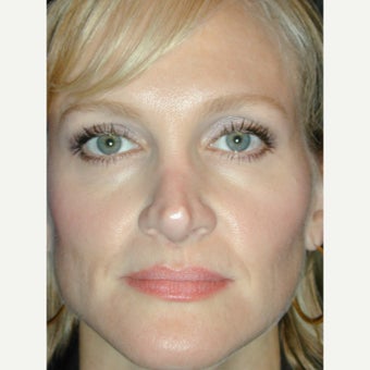 35 year old woman treated with Botox Browlift after 1936131
