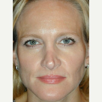 35 year old woman treated with Botox Browlift before 1936131