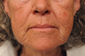 Perioral Dermabrasion before 725346