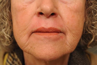 Perioral Dermabrasion after 725346