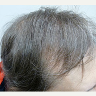 45 year old man treated with FUE Hair Transplant after 3724501