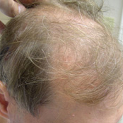 45 year old man treated with FUE Hair Transplant before 3724501
