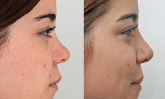 Rhinoplasty before 225883