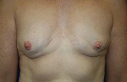Breast Implants before 241838