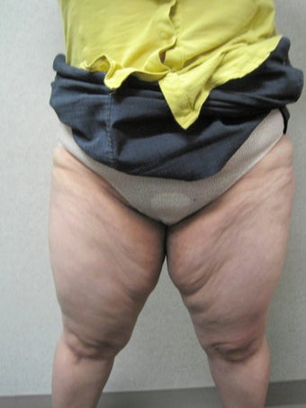 Inner Thigh Lift 328655
