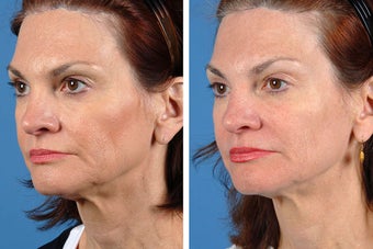 Fillers and Botox Cosmetic after 356475