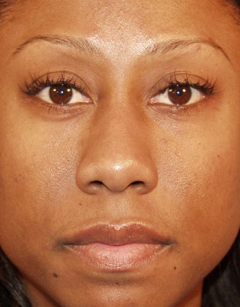 Rhinoplasty before 400980