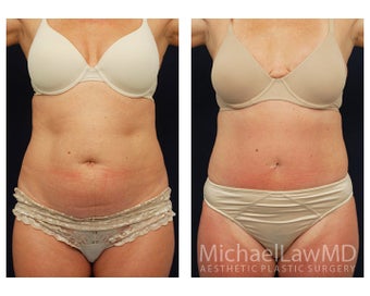 Tummy Tuck with Liposuction before 391629