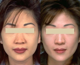 Buccal fat reduction before 123093