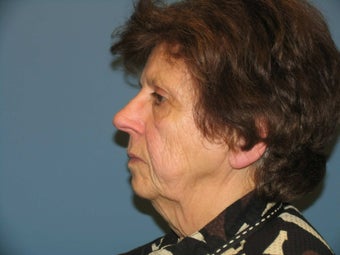 Quicklift w/neck liposuction before 580276
