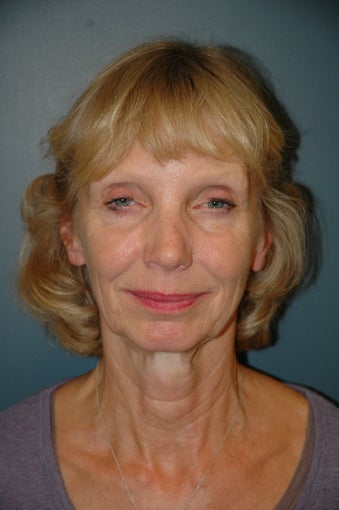 Facelift before 239904