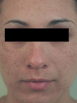 Laser Resurfacing before 89115