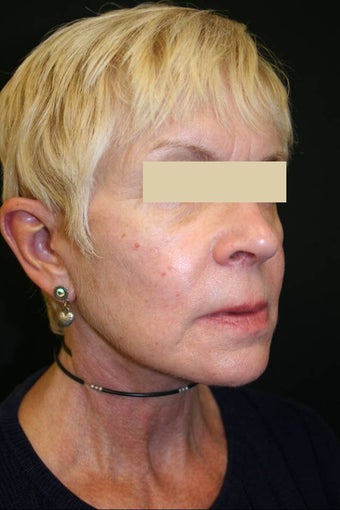 Sculptra after 137051