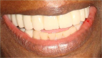 Dental Implants to replace full arch of teeth after 328056