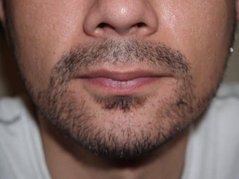 Facial Hair Transplant after 321260