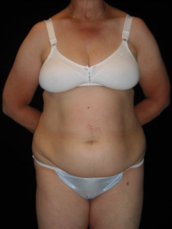 Abdominoplasty before 420080