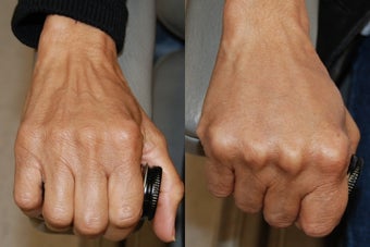 Hand Rejuvenation using Silikon-1000 before 173294