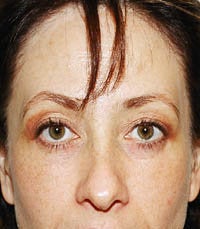 blepharoplasty (eyelids) after 219357