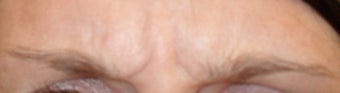 Dysport injections before 124631