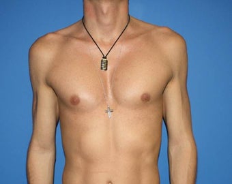 Pectoral Implants, Chest Augmentation after 402303