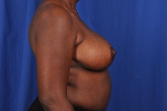 62 year-old woman desired bilateral breast reduction 647695