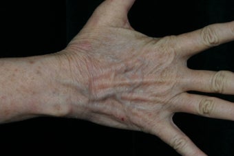 Dual Fraxel Laser after 309246