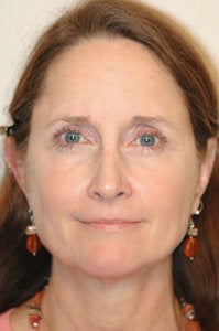 Mini face lift with endoscopic brow lift before 70987