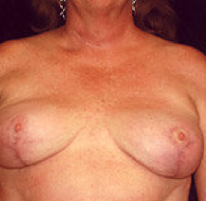 Breast implant removal and breast lift. after 316568