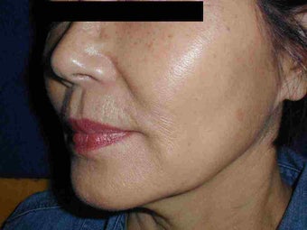 Sculptra before 108826