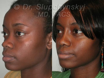 African American Rhinoplasty 565837