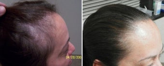 Female medical treatment for hair loss (no surgery) before 369183