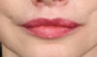 Lip lift after 519741