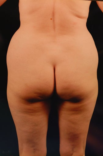 Liposuction before 457072