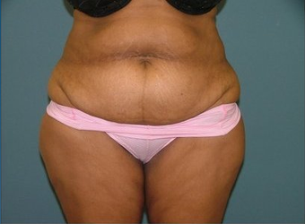 Tummy Tuck before 97008