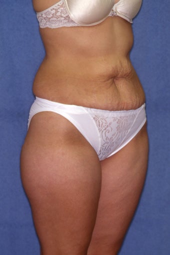 Tummy Tuck with Liposuction 410983