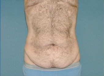 Tummy Tuck before 97007