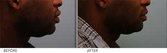 African American Lip Reduction after 421895