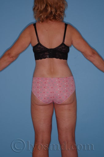 Lower Body Lift and Tumescent Liposuction after 233085