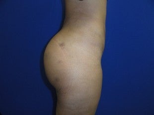Brazilian Butt Lift after 476130