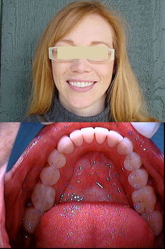 Invisalign after 109486