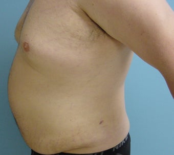 Male liposuction/liposculpture 314976