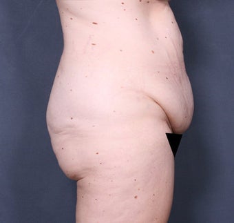 Body Lift 341226