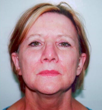 SmartXide CO2 Laser Resurfacing (DOT Therapy) after 587714