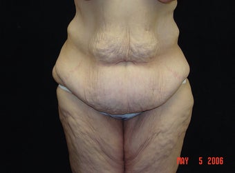 Body Lift, Outer Thigh Lift, Buttocks Lift before 203464
