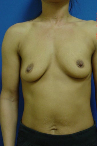 Breast Augmentation before 338418