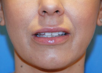 Lip Augmentation after 199328