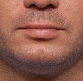 Chin Augmentation before 521701