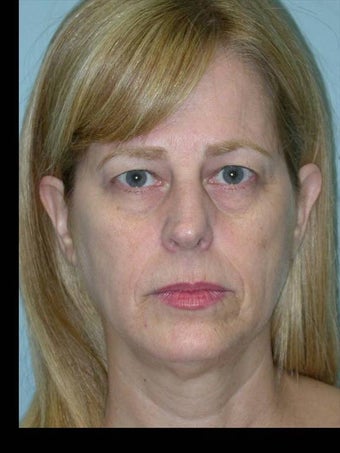 Full Facial Rejuvenation and Rhinoplasty before 182367