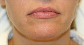 Lip Filler - Juverderm before 114510