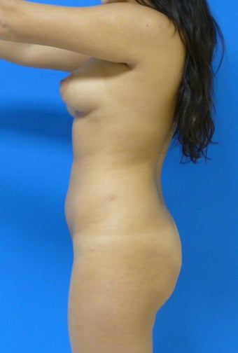 Brazilian Butt Lift 367236